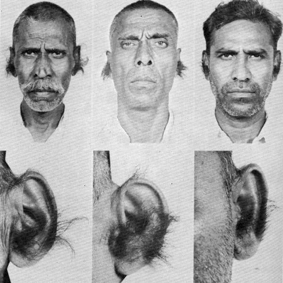 Congenital Hypertrichosis Universalis